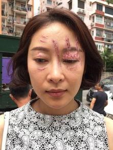 女明星毁容